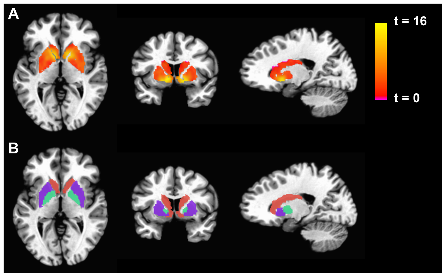 功能性磁共振成像（fMRI）脑部扫描